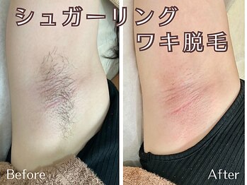 シエナ(ciena)/ワキ症例写真♪