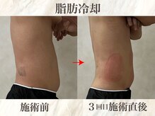 ウィボーテ(We Beaute)/【痩身】脂肪冷却×脂肪分解