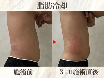 ウィボーテ(We Beaute)/【痩身】脂肪冷却×脂肪分解