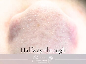 クウ(kuu)/【韓国式3D毛穴洗浄】途中経過