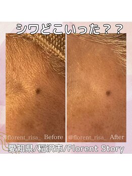 アーキ(ARCHI)/ヒト幹細胞導入エステ