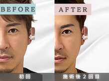 エルシンメトリー矯正院(ailesシンメトリー矯正院)/before＆after　ailes式小顔矯正