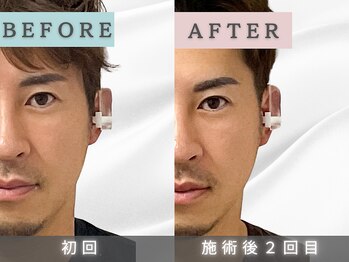エルシンメトリー矯正院(ailesシンメトリー矯正院)/before＆after　ailes式小顔矯正