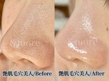 アンドモア(&more)の雰囲気（一度の施術でも艶肌毛穴美人へ）