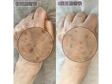 サロン マリー(SALON MARIE)/手のシミ改善・光フェイシャル♪