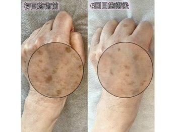 サロン マリー(SALON MARIE)/手のシミ改善・光フェイシャル♪