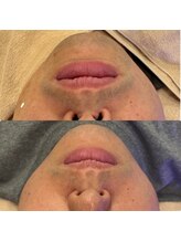 スリーズララ(Cerise LaLa)/ヒゲ脱毛のbefore→after