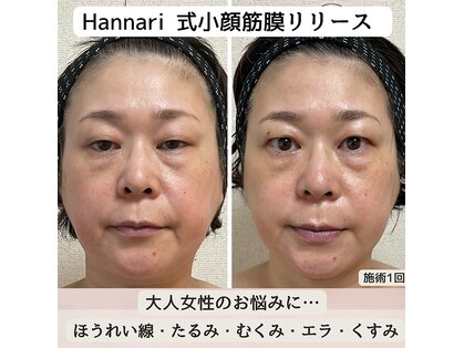 ハンナリ(Hannari)の写真