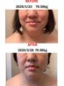 『憧れの小顔』を脂肪冷却で！お顔5回コース55,000円⇒52,250円（5％OFF）