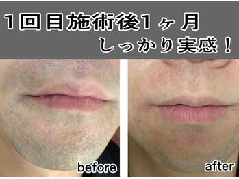 ヴェリテ(Verite)/男性ヒゲ脱毛 1回目から実感