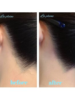 ラプレーヌ(La pleine)/うなじ脱毛