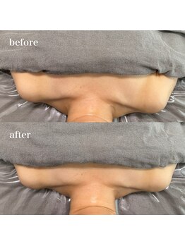 ベール(BEHL)/コルギのBefore After