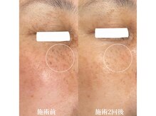 目元も可能、当日からメイクOK★季節問わず受けられるシミケア