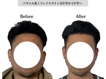 アロエベル(aloe Belle)/Before After（8回施術）