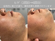 グランビューティーサロン(grand beauty salon)/ヒゲ脱毛のお客様