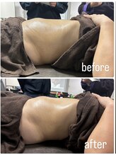 エトワール(etoile)/RED SHOT×キャビテーション