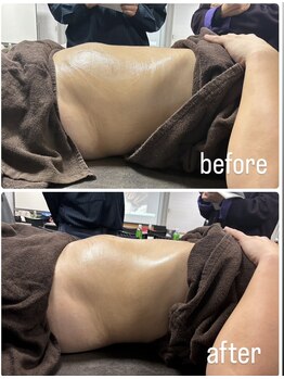 エトワール(etoile)/RED SHOT×キャビテーション