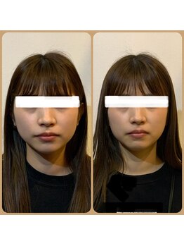 ロージースマイル(Rosy smile)の写真/骨から美容を叶える！顔悩みに速効性と持続力。筋肉刺激で脂肪燃焼！理想の小顔へ導きます♪
