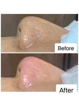 癒える(ielu)/【毛穴エクストラクション】B/A