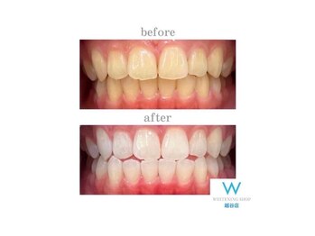 ホワイトニングショップ 越谷店/before&after美白ホワイトニング