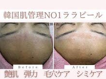 Cスキンケアクリニック 麻布店/ララピールBeforeAfter#艶肌