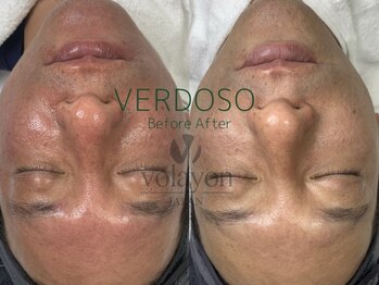 イヨヨ(iyoyo)/BeforeAfter