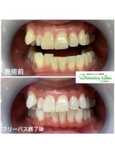 ホワイトニングサロン 名古屋駅店/【ホワイトニング施術例】