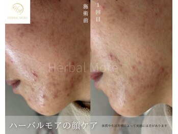 たくろう鍼灸院 豊田本院/【beforeAfter】