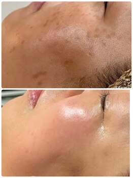 ビープラス(Biplus)/肌トラブル改善ハーブピーリング