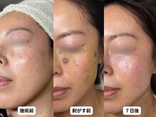 エングラッシー(en glassy)/BEFORE　AFTER　最新シミ回収