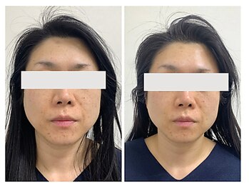 恵比寿脱毛 シーズ(She’s)/ソフトダーマ30代ビフォア