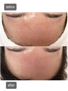 エムベル(M.belle)/リフトアップコース施術前後