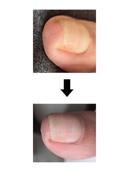 ホホホ(hohoho)/足爪ケア