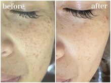 ホワイトアクア 梅田本店(WHITE AQUA)/ララピールでシミケア！梅田