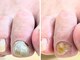 ユニコ(Unico)の写真/分厚くなった爪、巻き爪、ガサガサなかかとの角質等、頑張る足元の救世主☆足先までしっかりケアを◎