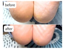 カシェット(Cachette)/40代女性◎足裏角質 かかと40分