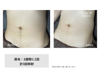 スタンド(STAND)/おなか脱毛