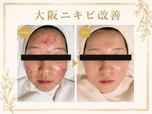 レゾン 京橋店の雰囲気（《完全個室で施術》当店一番人気のニキビケアコースで透明感UP！）