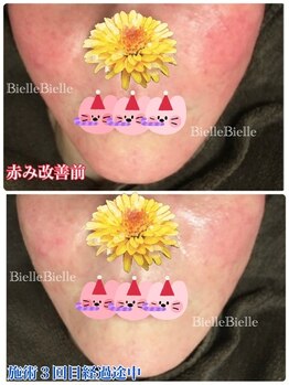 ビエル(Bielle)/他の肌改善エステで断られた