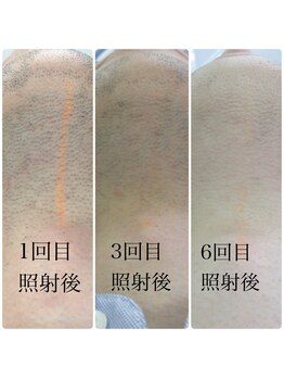 ラック(lac)/メンズひげ脱毛