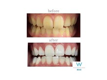 ホワイトニングショップ 越谷店/before&after美白ホワイトニング