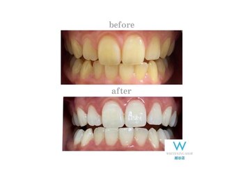 ホワイトニングショップ 越谷店/before&after美白ホワイトニング