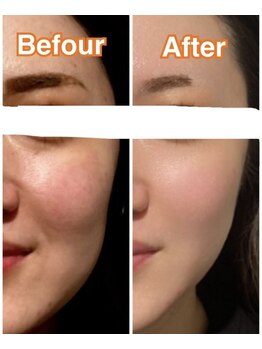 アンドグレイスプラス 恵比寿(&Grace+)/小顔レモンボトル&リフティング