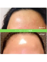 ティンクルホワイト 上尾店/ハーブピーリング施術後