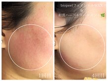 ラミーユ(La Miu)/WAX＆剥けないハーブピーリング