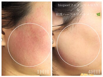 ラミーユ(La Miu)/WAX＆剥けないハーブピーリング