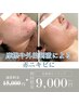 【お試し】乾燥から来る肌荒れ＆赤ニキビケア◎乳酸菌ピーリング