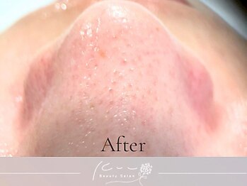 クウ(kuu)/【韓国式3D毛穴洗浄】After
