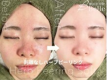 ベル 桜木町(Belle)/ハーブピーリング｜フェイシャル