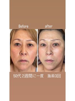 アデージョ(Adejio)/ララピール